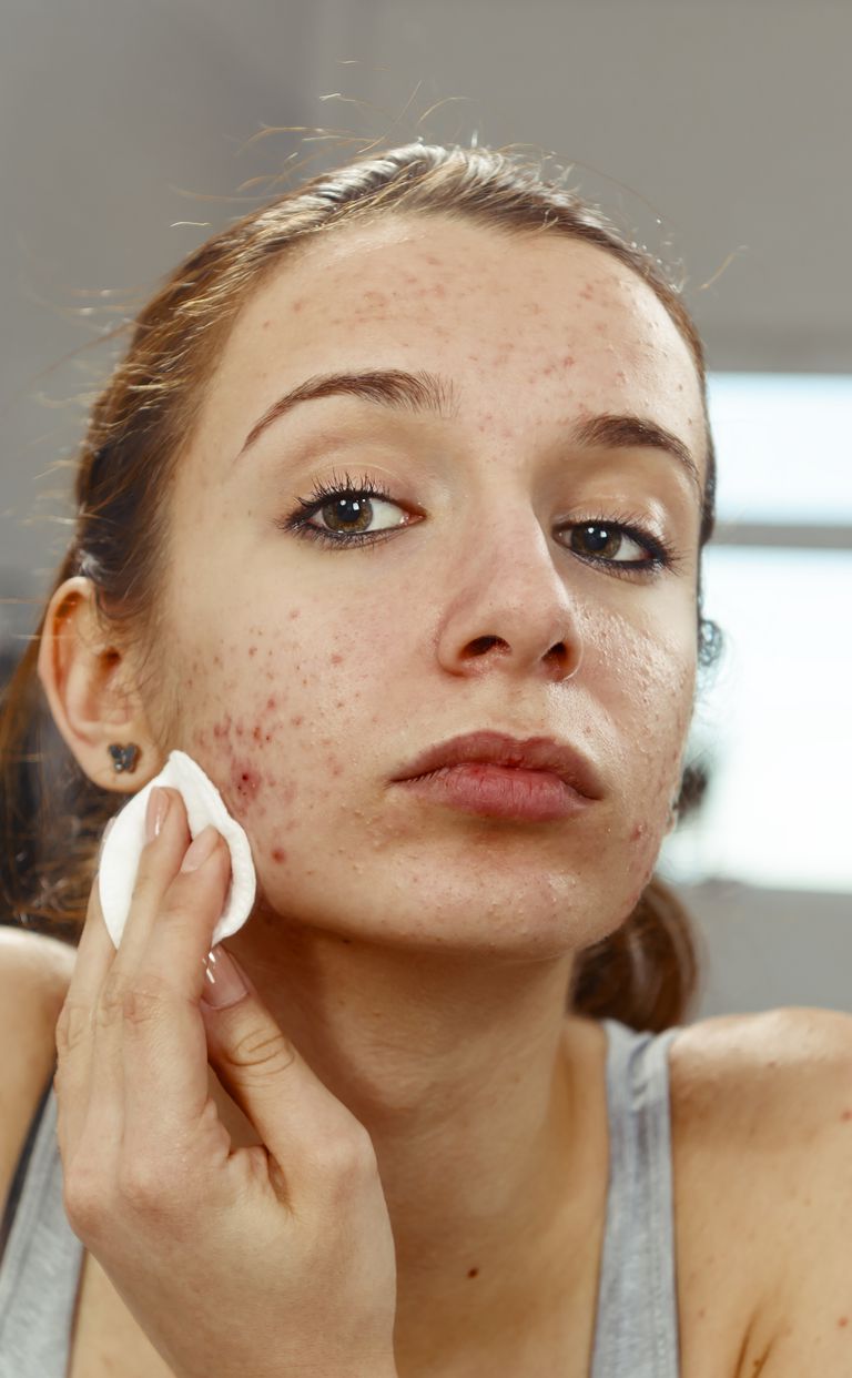 overskydende olie, rydde acne, acne behandling, Acne ikke, bedste måde