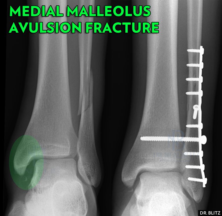 malleolære frakturer, mediale malleolære, medial malleolus, mediale malleolære frakturer