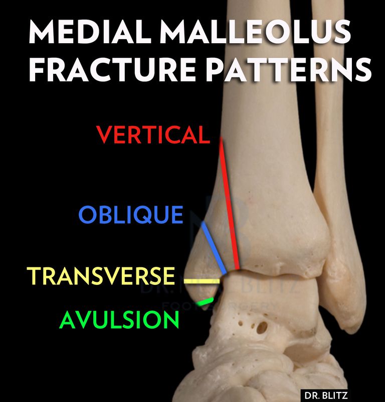 malleolære frakturer, mediale malleolære, medial malleolus, mediale malleolære frakturer
