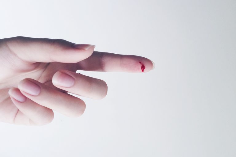 denne skade, alvorlige skader, fingerens spids, Gamekeeper Thumb