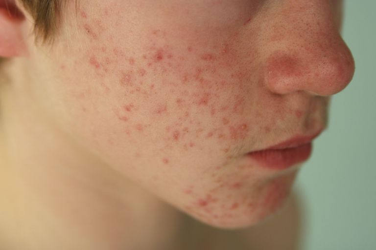 acne børnelæge, acne normalt, aktuelt antibiotikum, almindeligt anvendte, barns akne