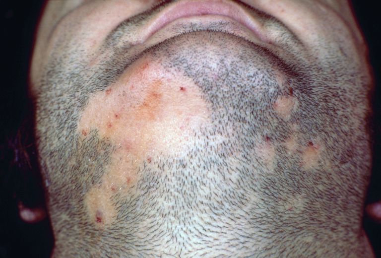 alopecia areata, flere forskellige