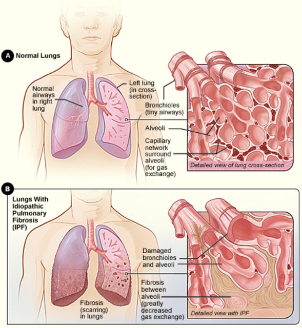 denne sygdom, blev konstateret, blev konstateret forekomsten, idiopatisk lungfibrose, konstateret forekomsten