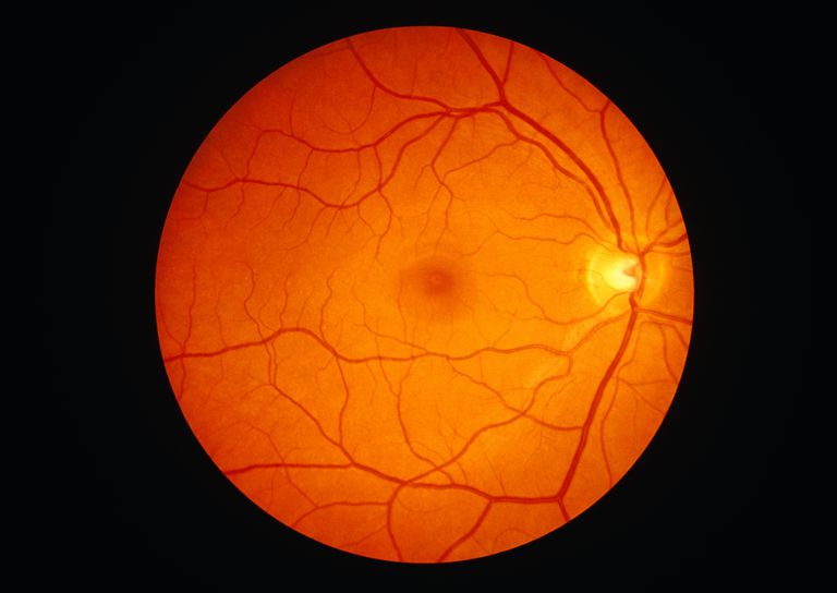 bagsiden ​​øjet, Central serøs, Central serøs retinopati, diabetisk retinopati, eller løsrivelse, Macular degeneration