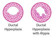 duktal hyperplasi, Atypisk duktal hyperplasi, udvikle brystkræft, atypisk duktal