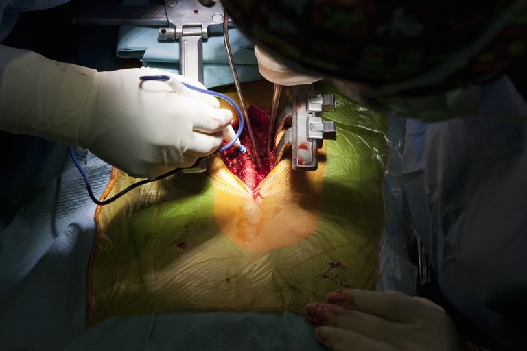 overvægtige patienter, eller derover, postoperative komplikationer, Academy Neurosurgeons, hjælpe reducere, kirurgiske instrument