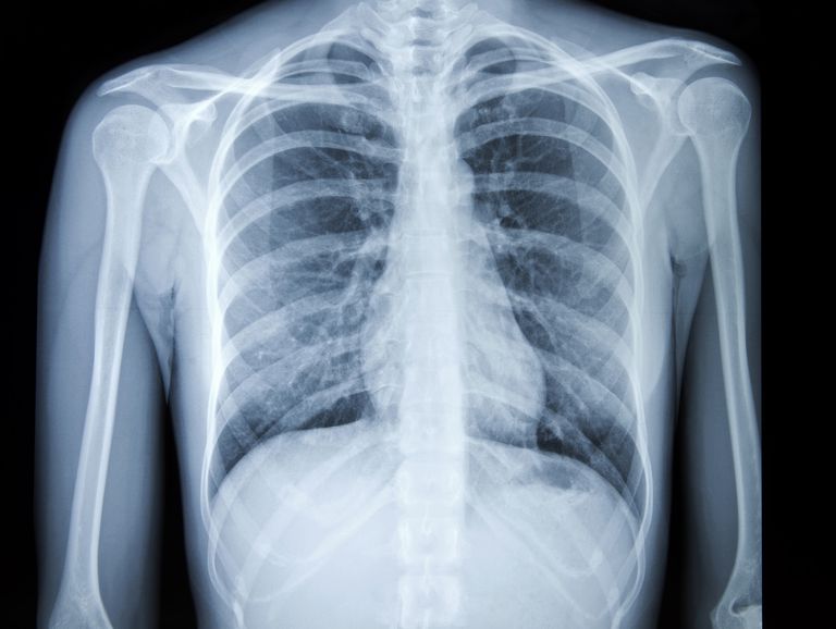diagnose lungekræft, symptomer lungekræft, bryst røntgen, bryst røntgenstråler, mere tilbøjelige