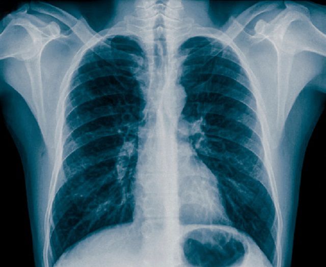 andre tilstande, bryst røntgen, hjerte eller, røntgen hjælper