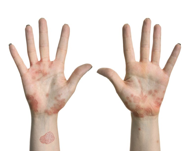 Auspitzs tegn, hænder fødder, Plaque-type psoriasis, Psoriasis hænder, Psoriasis hænder fødder