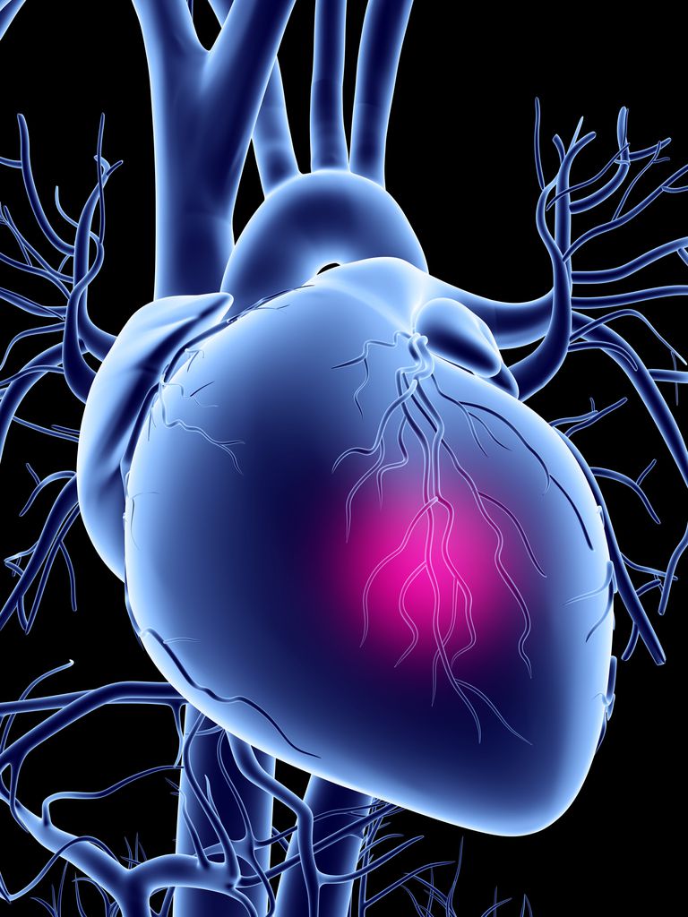 behovet hjertekateterisering, blokerede kranspulsårer, blokeringer stede, eller flere, hvilket forårsager