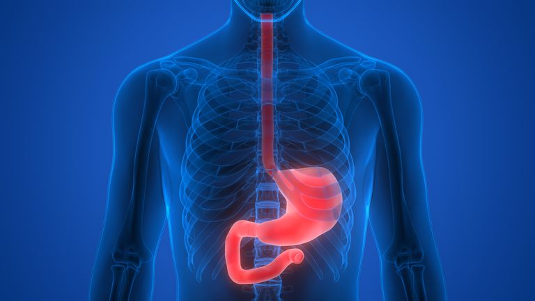 Crohns sygdom, Crohns sygdom spiserøret, sygdom spiserøret, øvre endoskopi