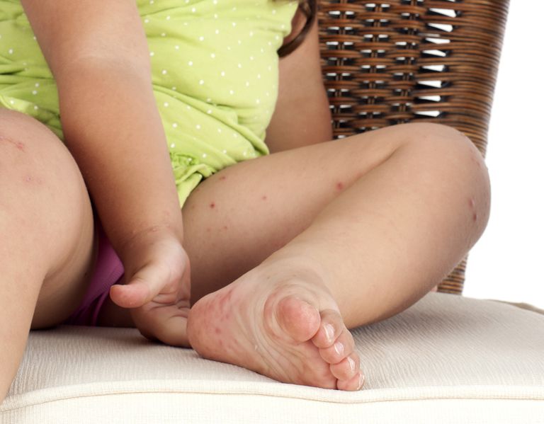 barns elveblest, allergisk reaktion, finde hvad, finde hvad forårsager, forårsager barns