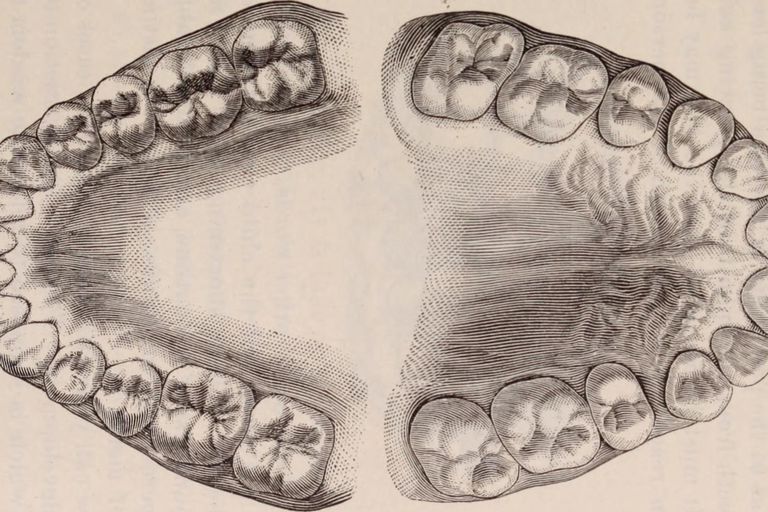ekstra tænder, molarer eller, deres placering, designet opretholde, designet opretholde store