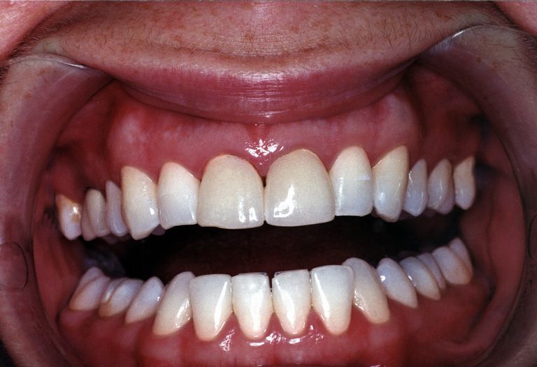 gingival tilbagetrækningsledning, ​​en gingival, ​​en gingival tilbagetrækningsledning, arbejdsbillede tanden, brugen ​​en, gingival tilbagetrækningskabel