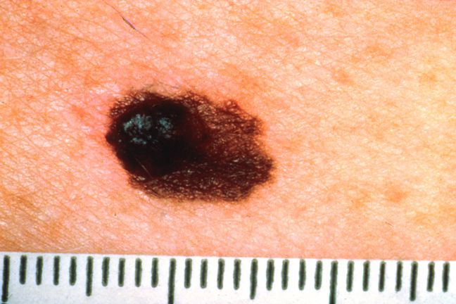 Normal Mole, kontakte læge, højere risiko, højere risiko udvikle, melanom tumor, risiko udvikle