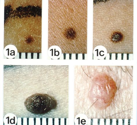 Normal Mole, kontakte læge, højere risiko, højere risiko udvikle, melanom tumor, risiko udvikle