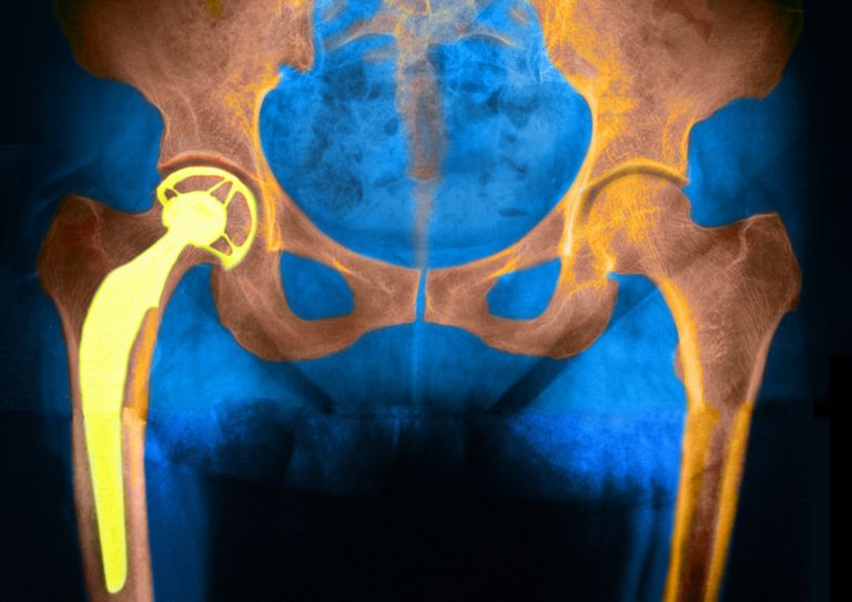hofte udskiftning, hofte udskiftninger, disse implantater, erstatning implantater, fælles udskiftning