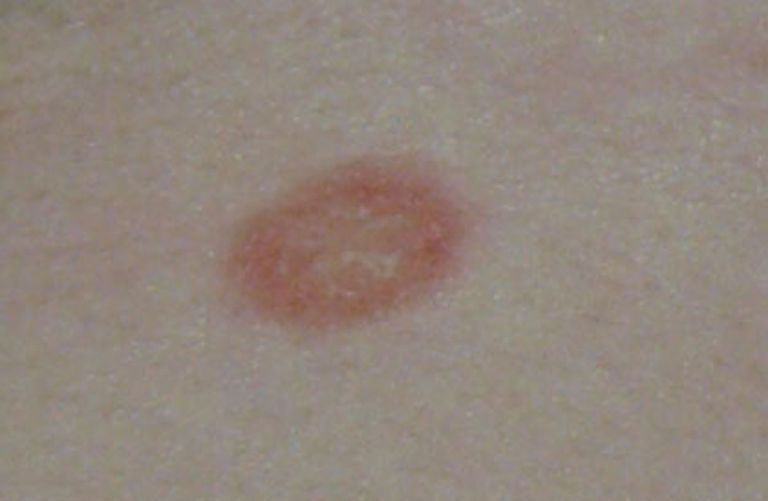 Pityriasis rosea, tinea pedis, ​​et udbrud, almindelige form, antivirale lægemidler