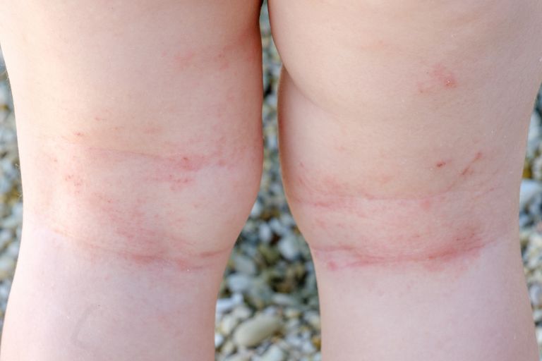 atopisk dermatitis, ældre børn