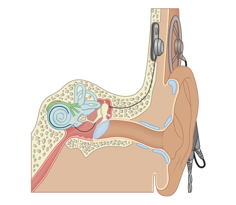 cochlear implantat, hybrid cochlear implantat, cochlear implantatet, hybrid cochlear