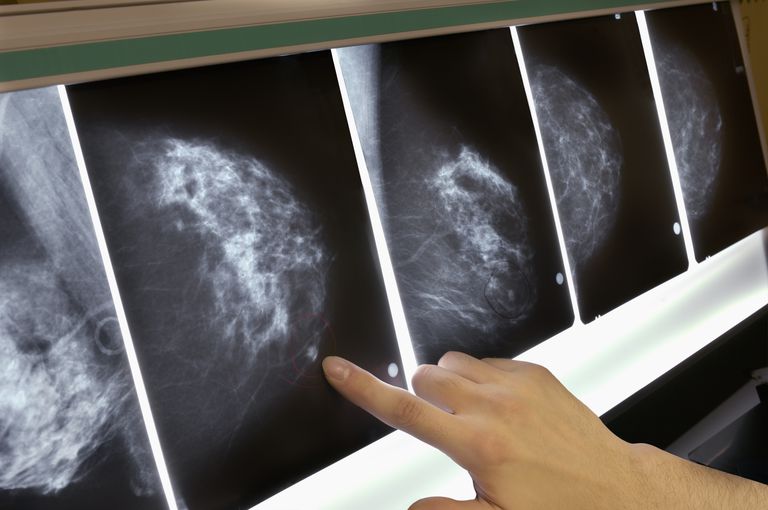 invasiv brystkræft, procent kvinderne, uregelmæssig disposition