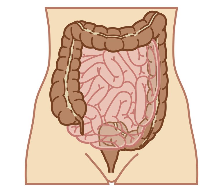 Crohns sygdom, Crohns sygdom ulcerøs, kolorektal cancer, kræve kirurgi, nogle tilfælde, sygdom ulcerøs