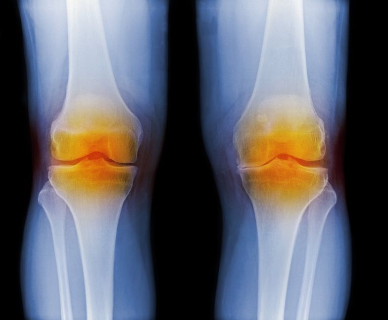 reumatoid arthritis, Fælles skade