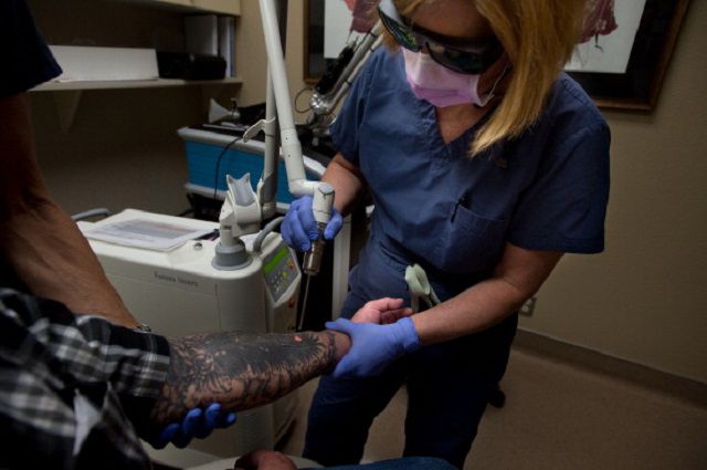 tatovering fjernelse, laser tatovering, laser tatovering fjernelse, andre metoder, fjerne tatovering, fjernelse laser