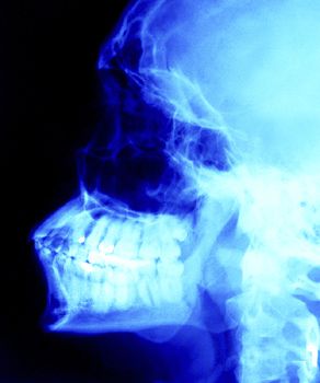 dental røntgenstråler, øget risiko, beskytte selv, behov ikke