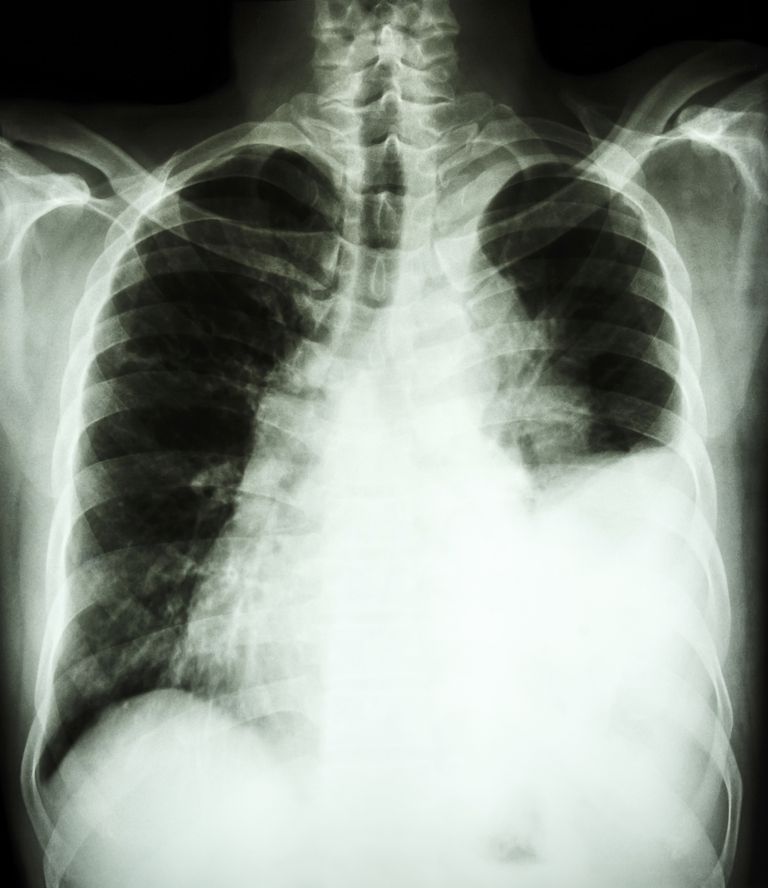 mennesker lungekræft, pleural effusion, procent procent, calcium blodet, forekommer procent, mange mennesker