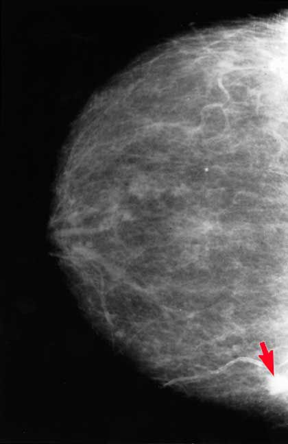 Nogle gange, ældre kvinder, Dette mammografi, Dette mammografi viser, disse billeder, mammografi viser