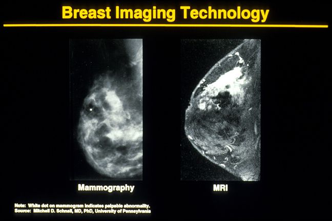 Nogle gange, ældre kvinder, Dette mammografi, Dette mammografi viser, disse billeder, mammografi viser