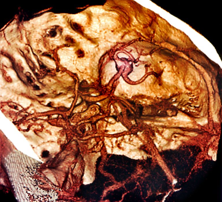 midterste hjernearterie, cortex styrer, højre hoved, måneder eller, side kroppen