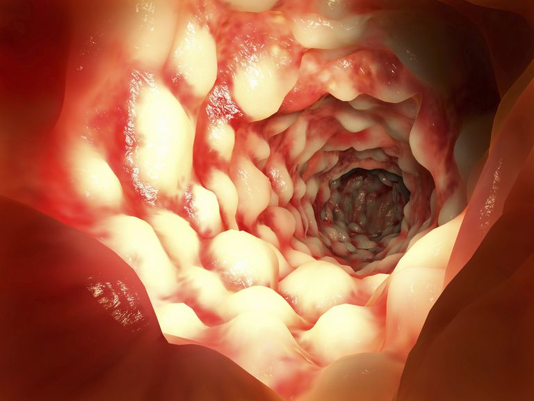 biologiske midler, Crohns sygdom, endnu ikke, bivirkninger Entyvio, cirkulerende inflammatoriske