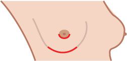 naturlige brystvorter, brystvandsbesparende mastektomi, dine naturlige, dine naturlige brystvorter