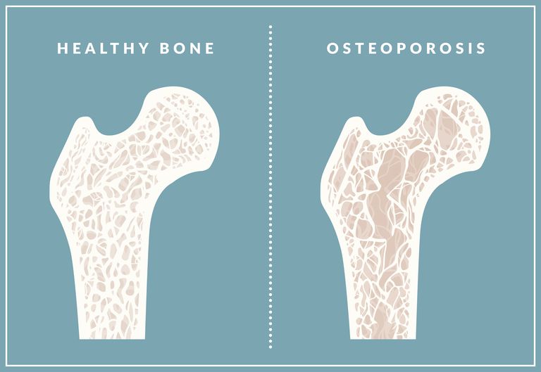 andre behandlingsmuligheder, behandling osteoporose, forebyggelse behandling, forebyggelse behandling osteoporose
