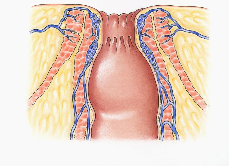 Crohns sygdom, anal sphincter, Anal stenose, eksterne muskel