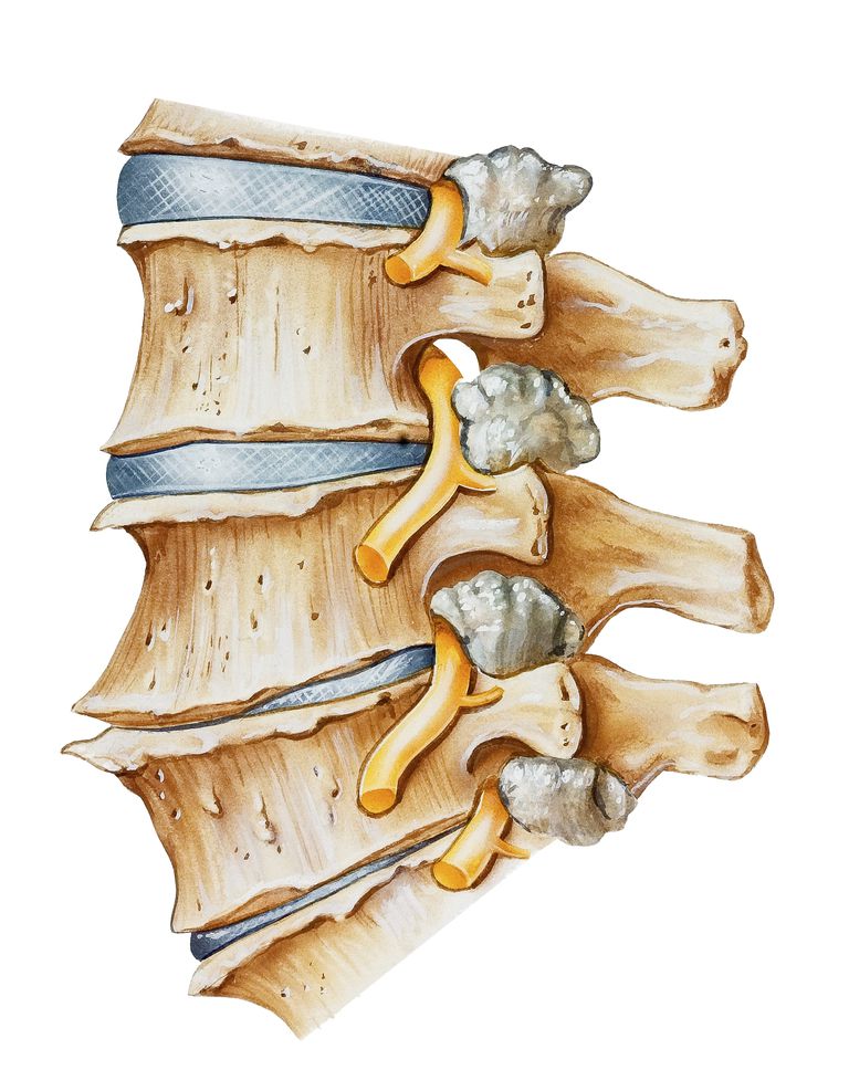 spinal arthritis, smerte eller, begge sider, facet joint, facet ledd