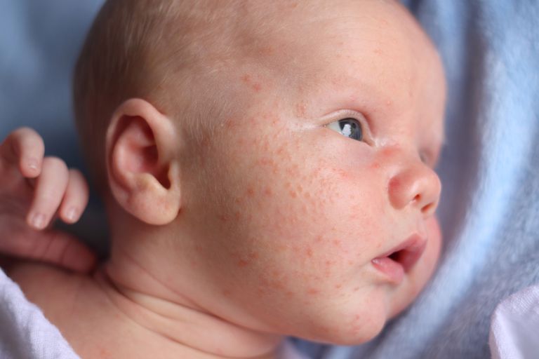 baby acne, infantil acne, babyer infantil