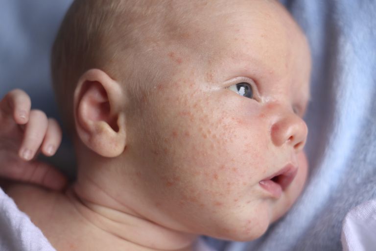 baby akne, baby acne, efter fødslen