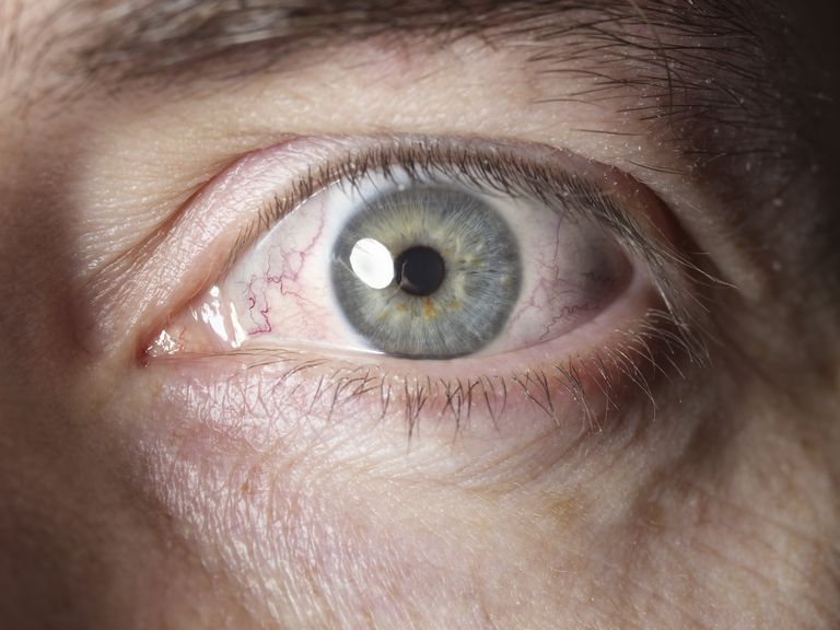 pharyngoconjunctival feber, dette tilfælde, føle bedre, indersiden ​​øjenlågene, også kendt