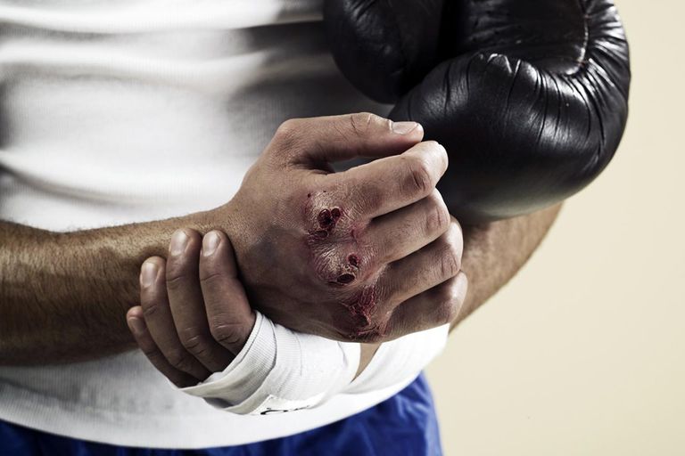 boxers brud, Boxer Fracture, efter boxers, boxers fraktur