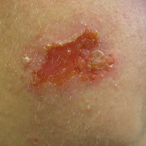 dette eksempel, eller tinea, forårsaget herpes, form impetigo