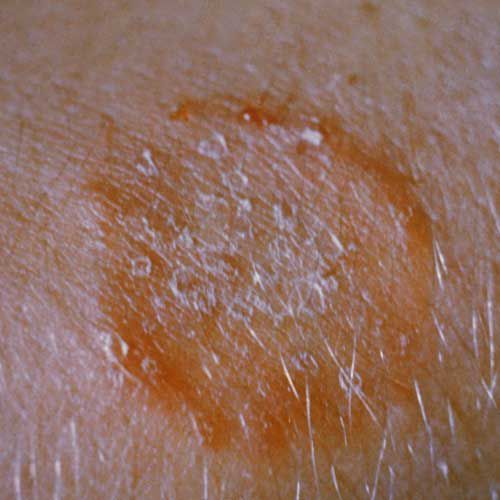 dette eksempel, eller tinea, forårsaget herpes, form impetigo