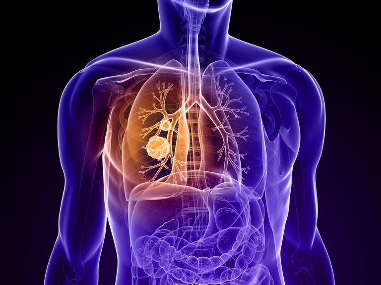 årsager lungemasse, mest almindelige, aldrig røget, Hvis læge, mere tilbøjelig