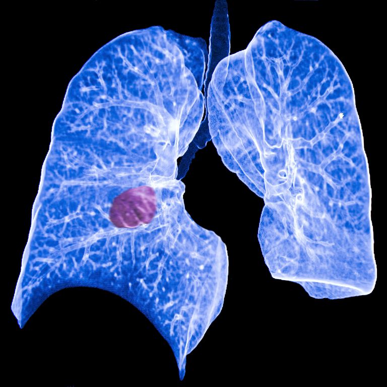 primær lungekræft, lungekræft metastatisk, lungekræft være, primær lungekræft metastatisk, spredes lungerne, anden lungekræft