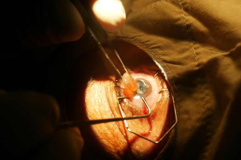 katarakt kirurgi, laser katarakt, laser katarakt kirurgi, vokser normalt langsomt, ​​din vision, bedst korrigerede
