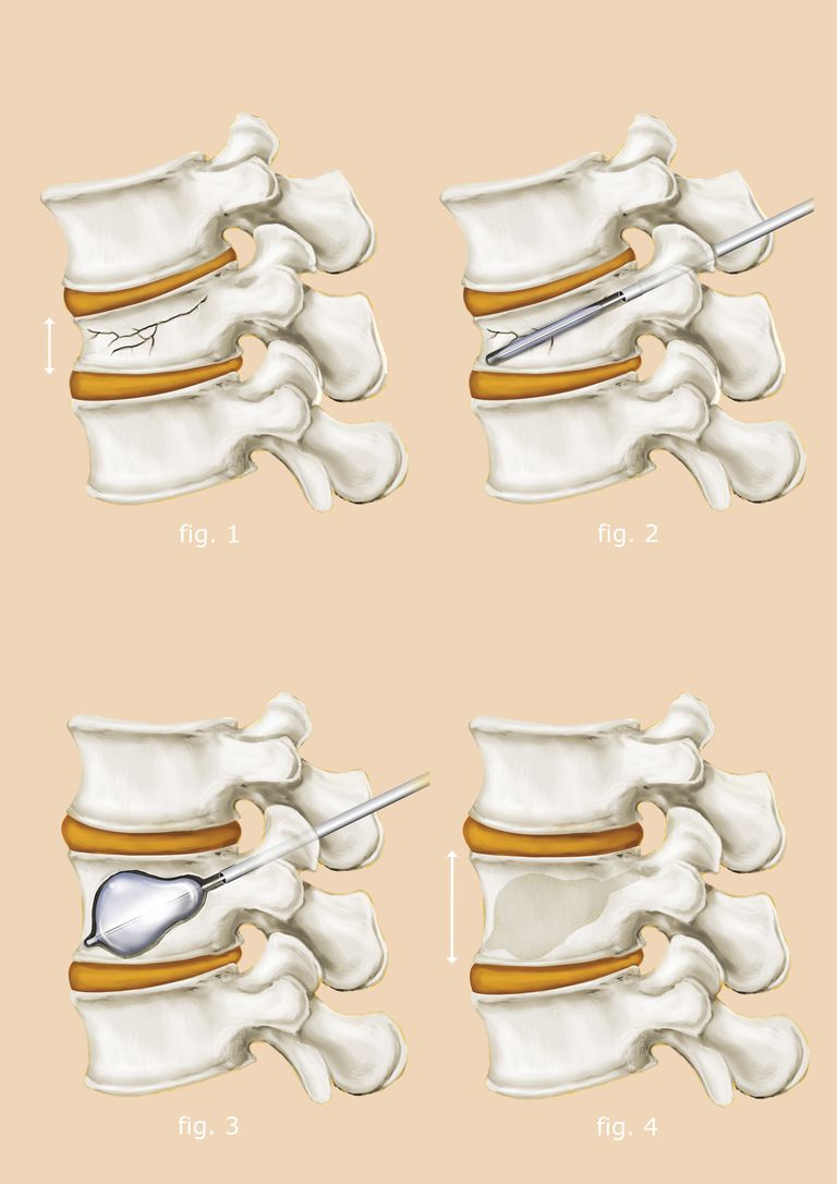 kyphoplasty vertebroplasty, være forbundet