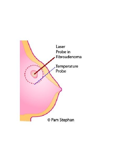godartede brysttumorer, generel anæstesi, laserablation godartede, laserablation godartede brysttumorer