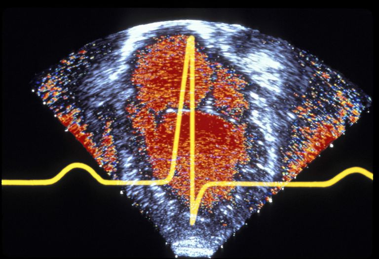 reumatisk hjertesygdom, strep hals, venstre ventrikel, atrium venstre, atrium venstre ventrikel, eller skarlagensfeber